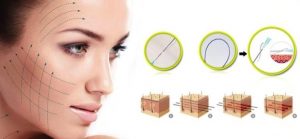Căng chỉ collagen - làm đẹp căng da mặt bằng chỉ collagen